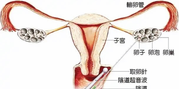 试管婴儿对女性的伤害大吗