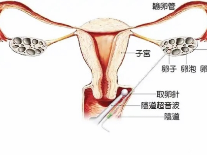 试管婴儿对女性的伤害大吗