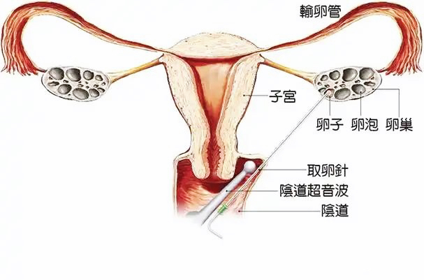 试管婴儿促排取卵，会对卵巢造成伤害吗？